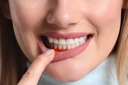 7 hậu quả nghiêm trọng nếu lười đánh răng