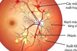 Điều trị biến chứng võng mạc do đái tháo đường