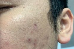 Nam thanh niên ở Hà Nội có hàng chục nốt sẩn trên má sau tiêm meso căng sáng da