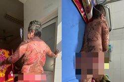 Bị hội chứng Lyell vì sử dụng thuốc nam không rõ nguồn gốc