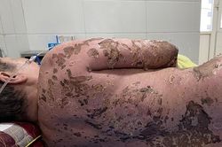 Bệnh viện Đa khoa tỉnh Thanh Hóa cứu sống bệnh nhân dùng thuốc nam không rõ nguồn gốc