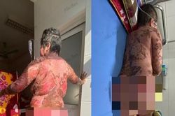 Thêm bệnh nhân suýt mất mạng vì uống thuốc nam chữa đau khớp