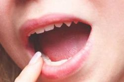 Xuất hiện triệu chứng này trong khoang miệng, hãy đi khám ngay bởi bệnh ung thư đã đến rất gần
