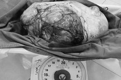 Giải thoát cô gái 28 tuổi khỏi khối u buồng trứng khổng lồ, nặng 6,5kg