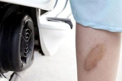 Xử trí khi bị bỏng pô xe máy