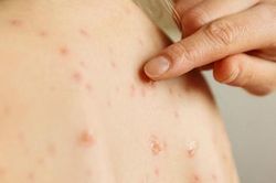 Bệnh thủy đậu diễn biến phức tạp tại Đắk Lắk