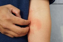Các trường hợp viêm da dị ứng ở trẻ em, thanh thiếu niên tăng