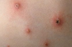 Bệnh thủy đậu diễn biến phức tạp tại Đắk Lắk