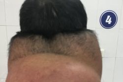 Tiêu thụ rượu nhiều, dễ có nguy cơ mắc bệnh hiếm gặp Madelung