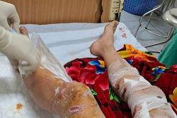 Lào Cai: Nam sinh bị chó thả rông cắn gây thương tích nặng