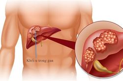 Tỷ lệ mắc ung thư gan ở Việt Nam đứng thứ 3 thế giới