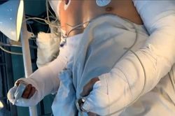 Nam công nhân bị đứt lìa cả 2 cẳng tay vì đồng nghiệp... sơ ý