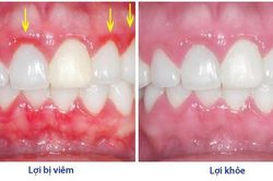 Điều trị viêm lợi bằng thuốc gì?