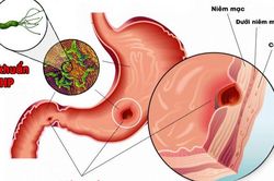 Cảnh báo chảy máu dạ dày ở người trẻ