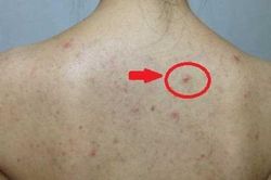 Thấy lưng mọc nhiều mụn, hãy cảnh giác với lời 'báo động đỏ' từ cơ thể