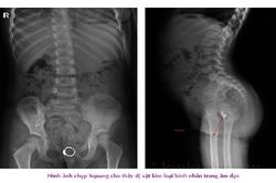 Chiếc nhẫn 'đi lạc' trong vùng kín của bé gái 4 tuổi