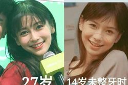 Angelababy sở hữu nhan sắc bao năm không đổi nhờ tip niềng răng đặc biệt
