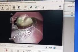 Sản phụ nhập viện khẩn cấp do nuốt 'mật lợn'