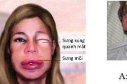 Phù mạch di truyền làm gì để kiểm soát?