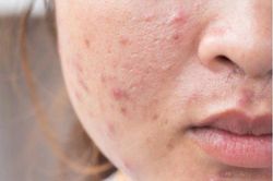 4 bệnh về da thường gặp khi thời tiết nắng nóng