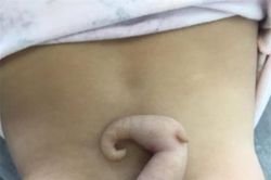 Bé gái chào đời với chiếc đuôi dài 6cm