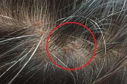 Lý do bạn bị nổi mụn trên da đầu