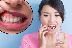 Viêm quanh răng: Nguyên nhân, biểu hiện và điều trị