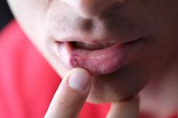 Khi nào virus gây u nhú ở người có thể tiến triển ung thư?