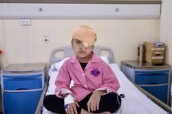 Phẫu thuật thành công loại bỏ u quái ác hốc mắt cho bé 4 tuổi