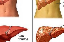 Cơ thể có 1 trong 7 dấu hiệu này chứng tỏ gan của bạn đang 'kêu cứu'
