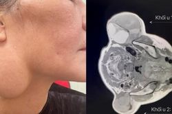 Loại bỏ thành công khối u tuyến nước bọt khổng lồ đeo đẳng người phụ nữ 60 tuổi