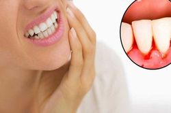 Viêm quanh răng mạn tính và cách chữa
