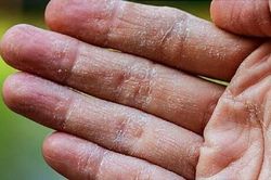 Dùng mật ong trị khô da tay chân hiệu quả