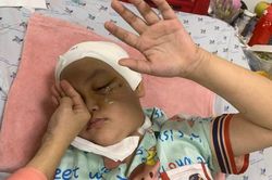 Bé gái 9 tuổi bị tay phanh xe đâm vào ổ mắt trái và nhu mô não