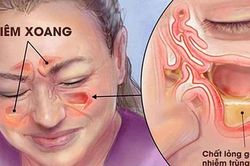 6 biện pháp đơn giản phòng ngừa viêm xoang