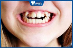 Niềng răng trẻ em: Tất tần tật những thông tin cha mẹ cần biết