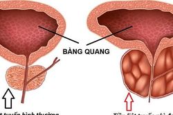 U phì đại tiền liệt tuyến: Nguyên nhân, hậu quả và phương hướng điều trị