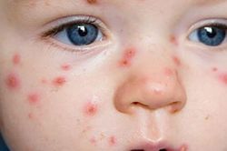 Bệnh thủy đậu ở trẻ: Nguyên nhân, triệu chứng và các biện pháp điều trị