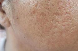 3 phương pháp thẩm mỹ giúp điều trị sẹo lõm thủy đậu