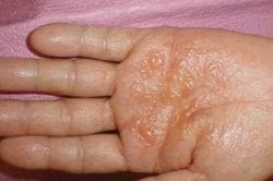 Bệnh tổ đỉa: Nguyên nhân và các phương pháp điều trị