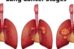 Các giai đoạn sớm của ung thư phổi cần biết