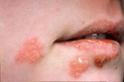 Cảnh báo gia tăng các bệnh lây truyền qua đường tình dục, vi khuẩn gây bệnh lậu kháng thuốc