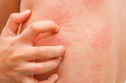 Nổi mề đay, chữa thế nào?