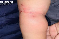 Trẻ bị nhiễm khuẩn huyết từ vết muỗi đốt