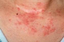 Cảnh giác với viêm da dị ứng