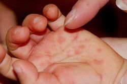 Dịch tay chân miệng đang vào mùa - lưu ý để bệnh không trở nặng