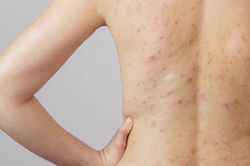 Chữa viêm lỗ chân lông hiệu quả bằng loại quả quen thuộc