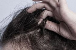 Thuốc trị bệnh Alzheimer có thể làm giảm chứng rối loạn giật tóc