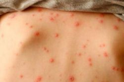 Dịch bệnh thủy đậu tiếp tục tăng tại Hà Nội