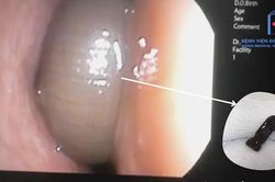 Phát hiện con đỉa dài 6cm sống hơn 3 tháng trong mũi bệnh nhân 50 tuổi